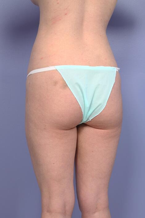 Liposuction Before & After Image