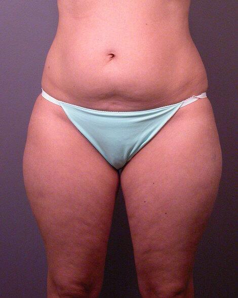 Liposuction Before & After Image