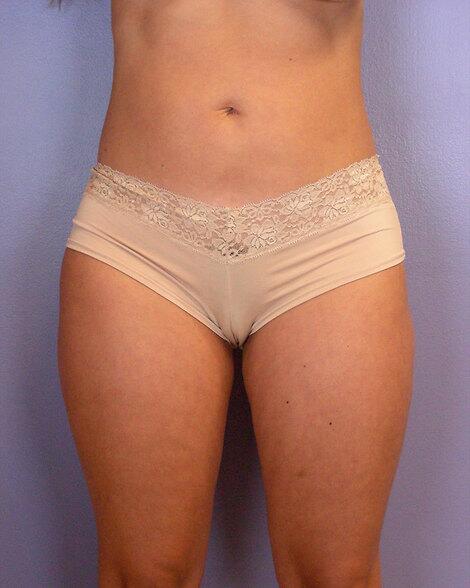 Liposuction Before & After Image