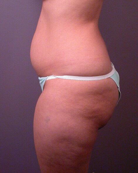 Liposuction Before & After Image