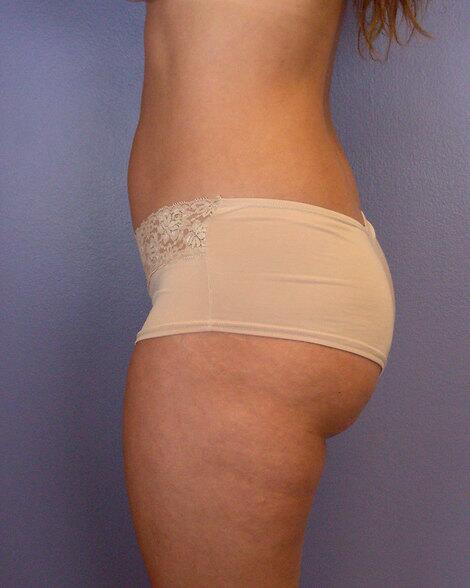 Liposuction Before & After Image