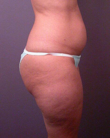 Liposuction Before & After Image