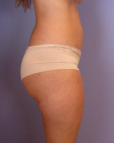 Liposuction Before & After Image