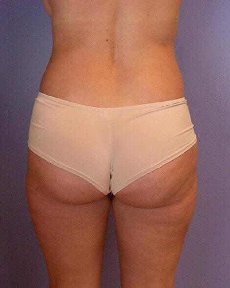 Liposuction Before & After Image