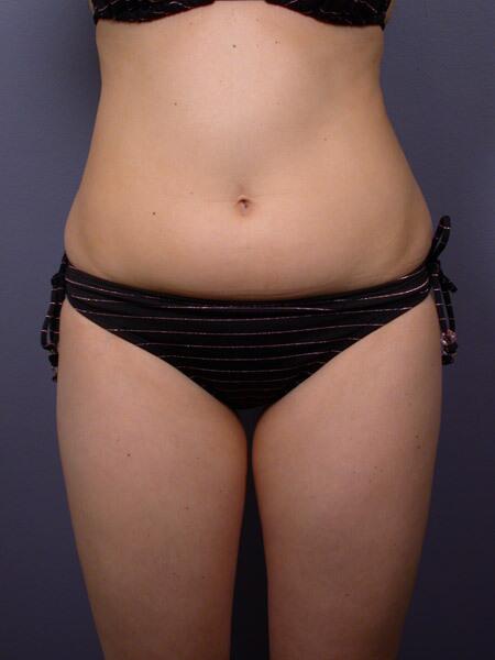 Liposuction Before & After Image