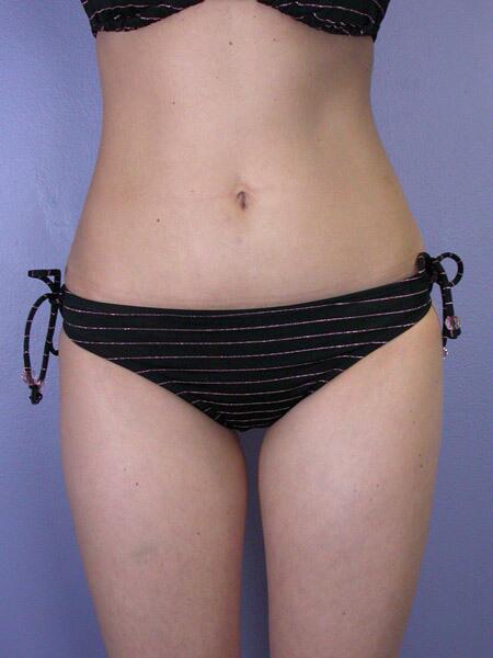 Liposuction Before & After Image