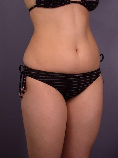 Liposuction Before & After Image