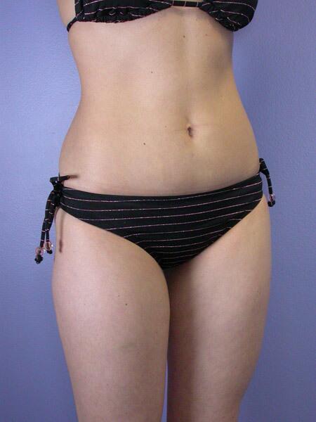 Liposuction Before & After Image