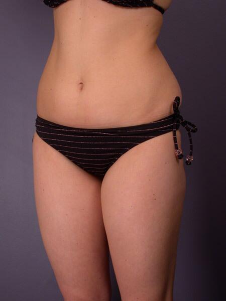 Liposuction Before & After Image