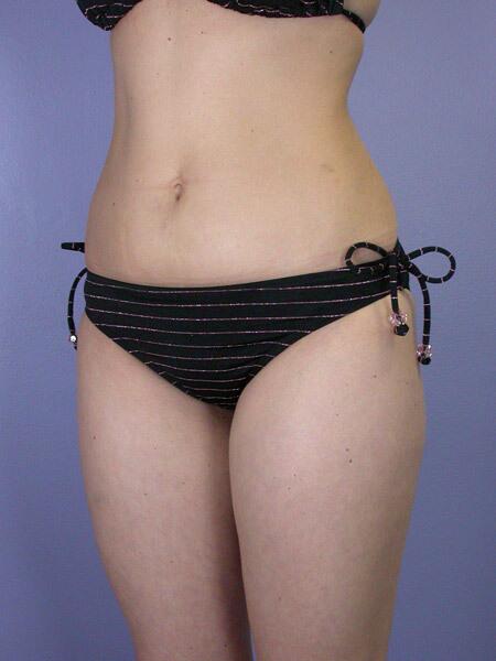 Liposuction Before & After Image