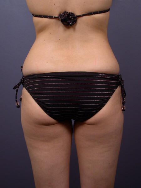 Liposuction Before & After Image