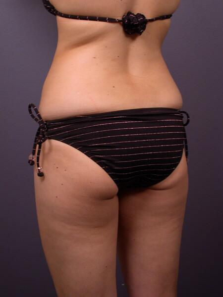 Liposuction Before & After Image