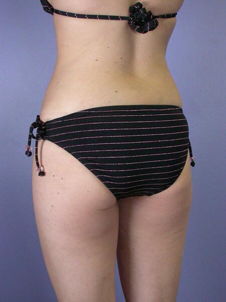 Liposuction Before & After Image