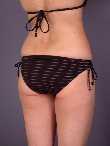 Liposuction Before & After Image