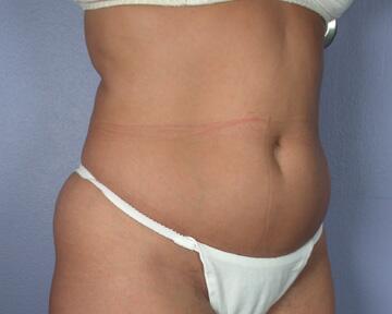 Liposuction Before & After Image