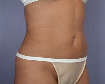 Liposuction Before & After Image