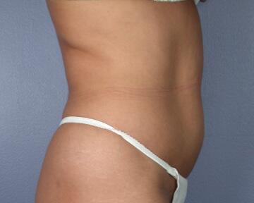 Liposuction Before & After Image