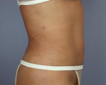 Liposuction Before & After Image