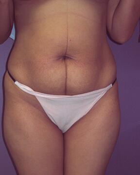 Liposuction Before & After Image