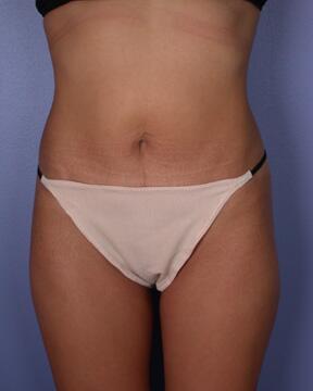 Liposuction Before & After Image