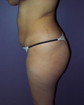 Liposuction Before & After Image