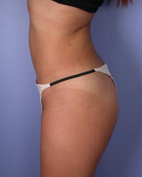 Liposuction Before & After Image