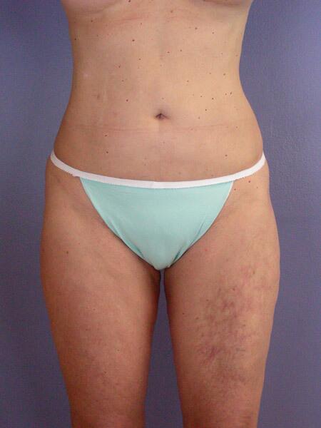 Liposuction Before & After Image