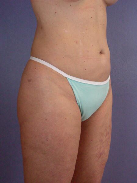 Liposuction Before & After Image