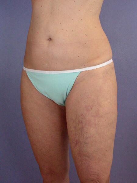 Liposuction Before & After Image