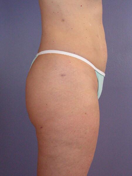 Liposuction Before & After Image