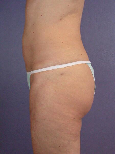 Liposuction Before & After Image