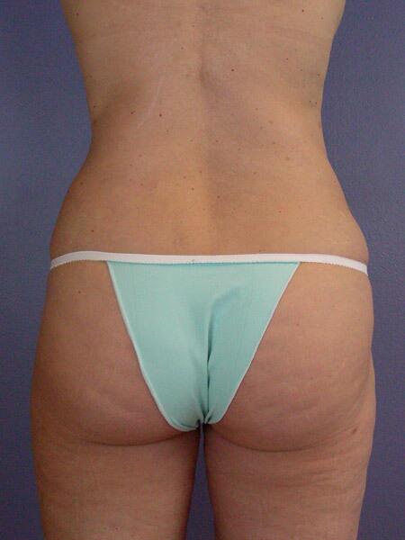 Liposuction Before & After Image