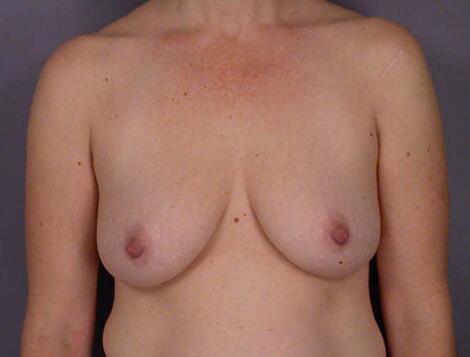 Liposuction Before & After Image