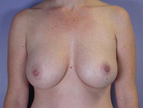 Liposuction Before & After Image