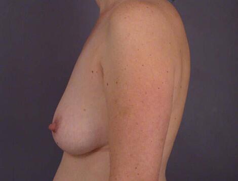 Liposuction Before & After Image