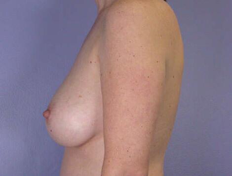 Liposuction Before & After Image