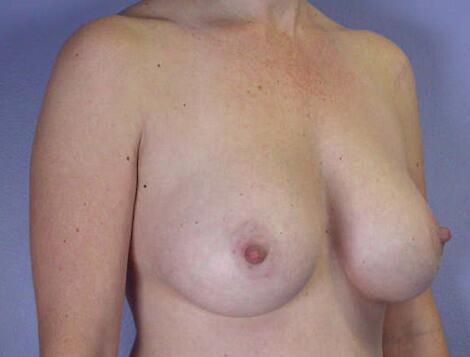 Liposuction Before & After Image