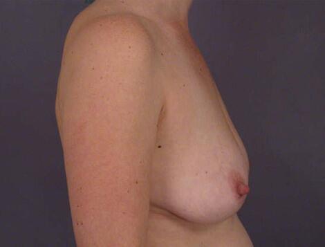 Liposuction Before & After Image