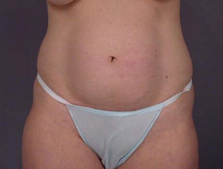 Liposuction Before & After Image