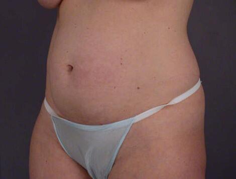 Liposuction Before & After Image