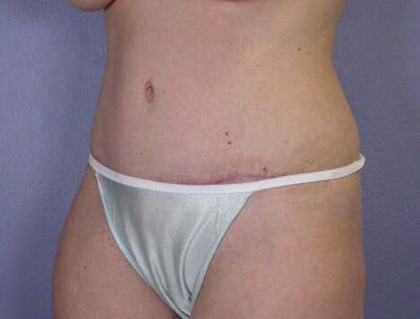 Liposuction Before & After Image