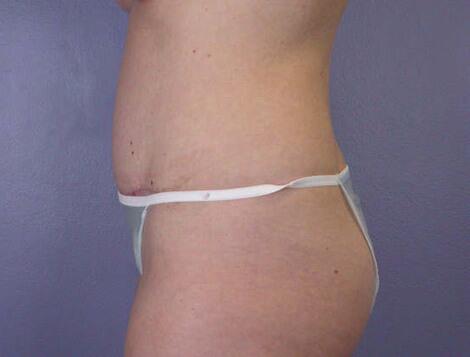 Liposuction Before & After Image