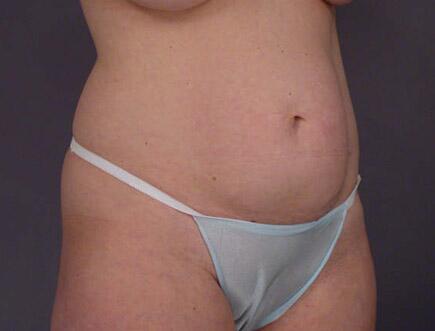 Liposuction Before & After Image