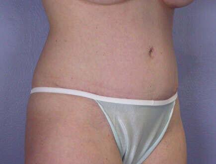 Liposuction Before & After Image