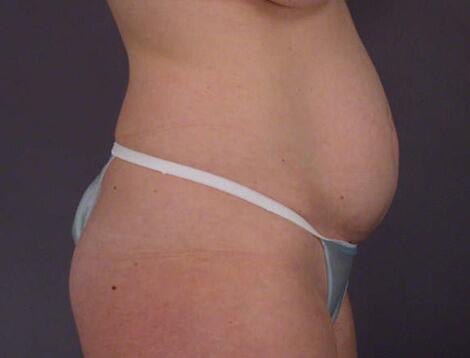 Liposuction Before & After Image