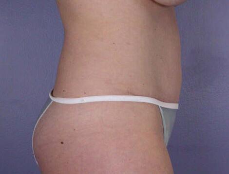 Liposuction Before & After Image