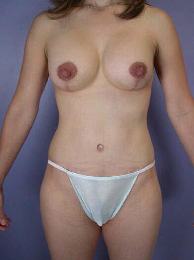 Liposuction Before & After Image