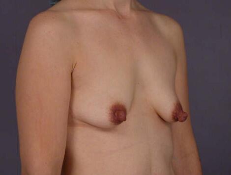 Liposuction Before & After Image