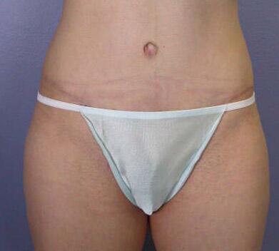 Liposuction Before & After Image