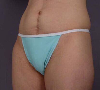 Liposuction Before & After Image